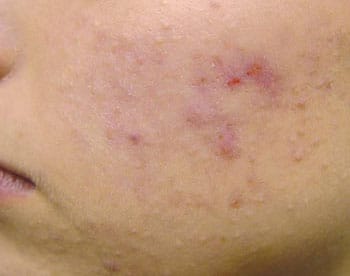 Eliminación de marcas de acné láser